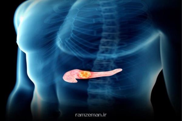 جلوگیری از گسترش سرطان لوزالمعده با یک پروتئین