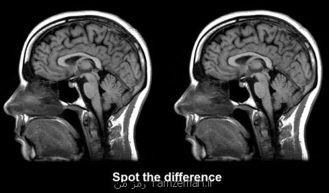 تعیین میزان هوش افراد با اسكن مغزی