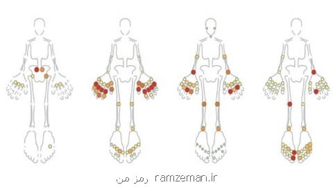 تشخیص محل دقیق درد بیماران مبتلا به آرتریت ممكن شد